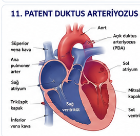 Aorta ile pulmoner arter arasında açık duktus arteriyozusu gösteren şema