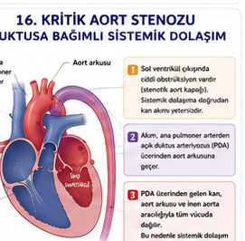 Aort kapak darlığının anatomik şeması
