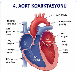 Aort koarktasyonundaki daralmayı gösteren şema