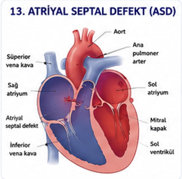 Atriyal septal defektte atriyumlar arasındaki açıklığı gösteren şema