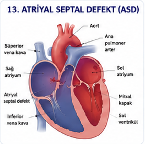 Atriyoventriküler septal defekt ve ortak atriyoventriküler kapağı gösteren şema