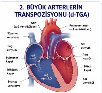 Büyük arterlerin transpozisyonunda paralel dolaşımları gösteren şema
