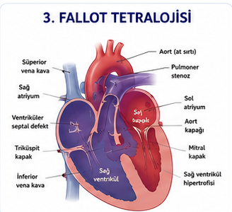Fallot tetralojisinin dört anatomik bileşenini gösteren şema