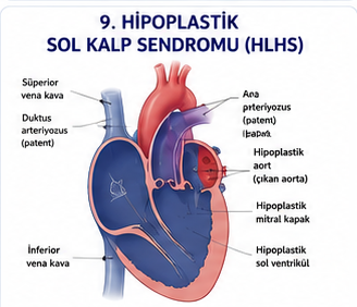 Hipoplastik sol kalp sendromunda küçük sol kalp yapılarını gösteren şema