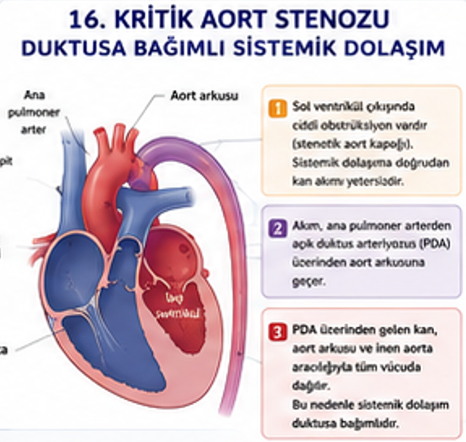 Kritik aort kapak darlığında sol ventrikül çıkış engelini gösteren şema