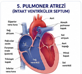 Pulmoner atrezide pulmoner çıkışın ve duktus bağlantısının şematik görünümü