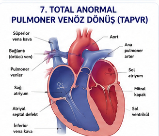 Tam anormal pulmoner venöz dönüşün şematik anatomisi