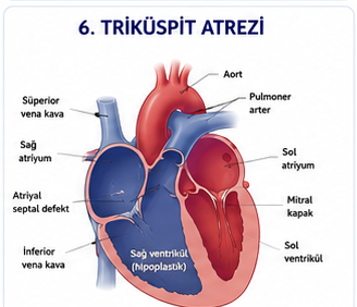 Triküspit atrezisi ve hipoplastik sağ ventrikül şeması
