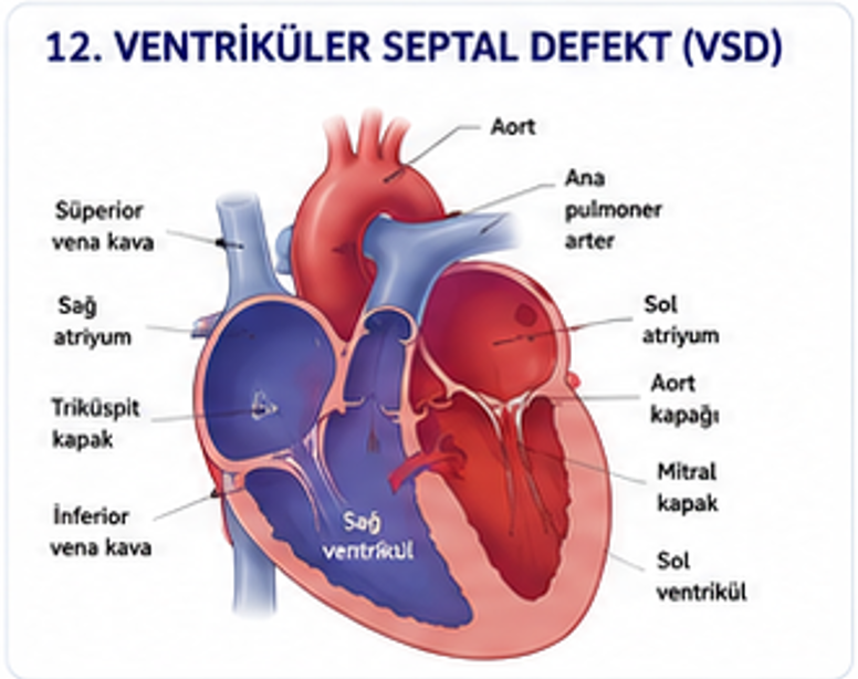 Ventriküler septal defektte ventriküller arasındaki açıklığı gösteren şema